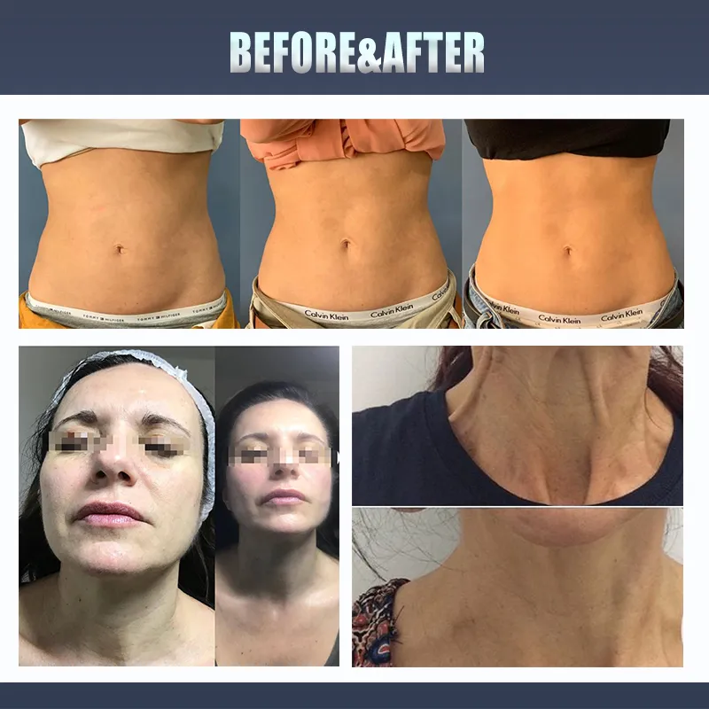 Hifu Machine Professional 5D V Max 8 Cartridges 11 Line 25000 Shots for Body Slimming