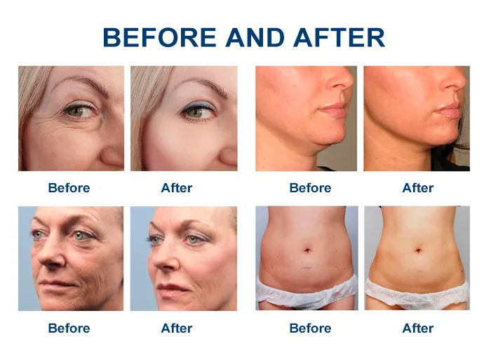 High Quality Face Lift Moisturizer Skin Tightening Anti-Puffiness Mini Face Lift Painless Hifu Machine